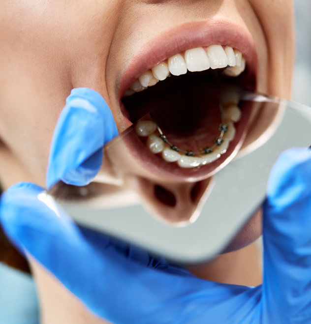 How lingual braces work