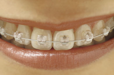 The clear alternative to traditional metal braces