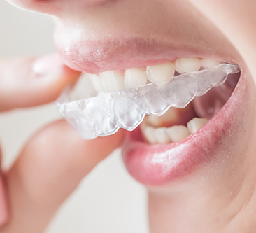 Invisalign® clear aligners