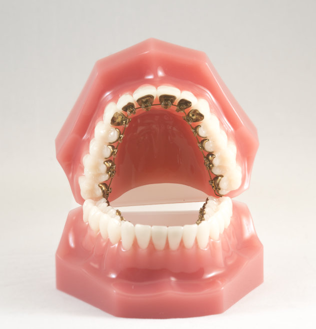 Why choose SmileLux for lingual braces?