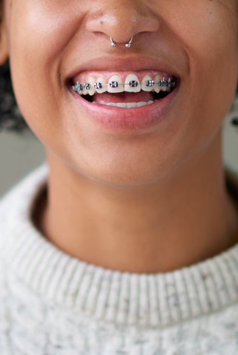 Metal fixed braces