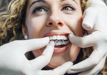 Custom-made orthodontic aligners 