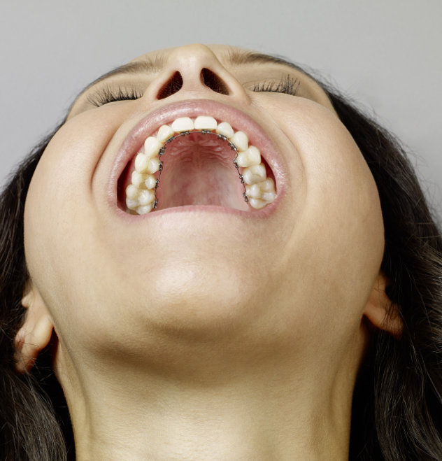 Benefits of lingual braces