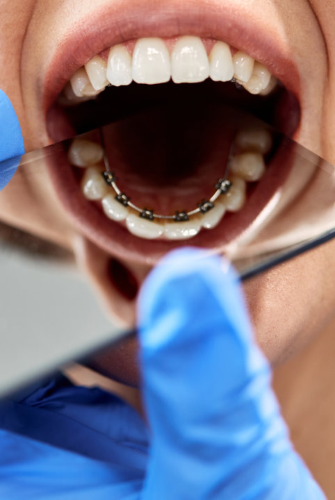 Lingual hidden braces