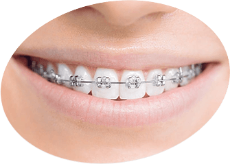 Metal Braces Metal Braces