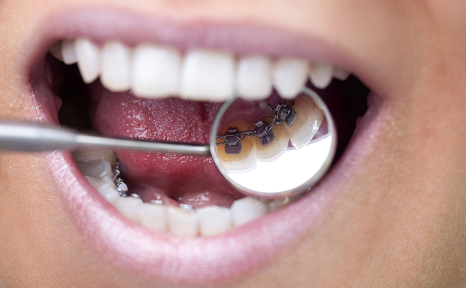 Lingual braces