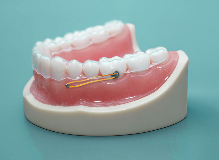 Temporary Anchorage Devices (TADs)