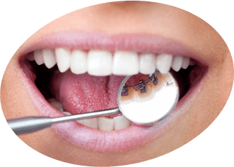 Lingual Braces Lingual Braces