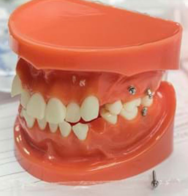 How are TADs placed?