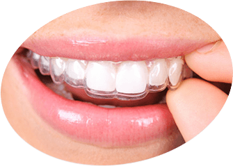 Invisalign Invisalign